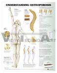   Understanding Osteoporosis Anatomical Chart